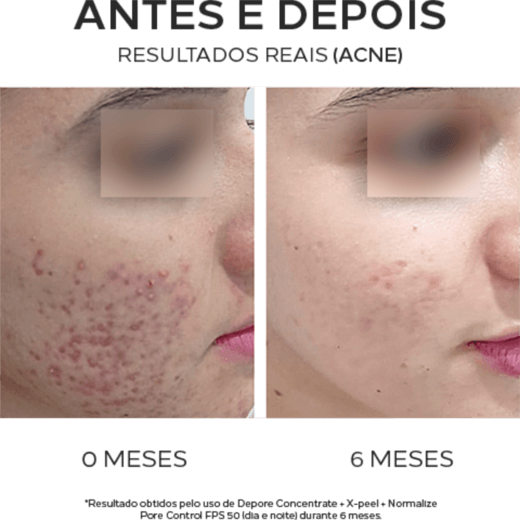 Antes e depois em 6 meses: redução das marcas de acne