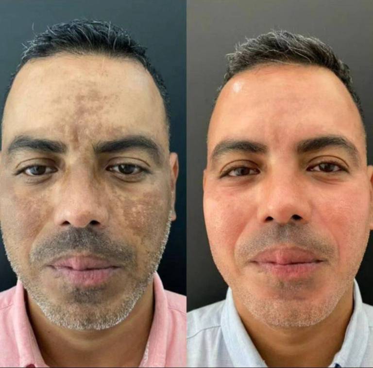 Antes e depois: pele masculina com tom mais uniforme